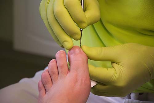 Treating in-growing toe nail Treating in-growing toe nail